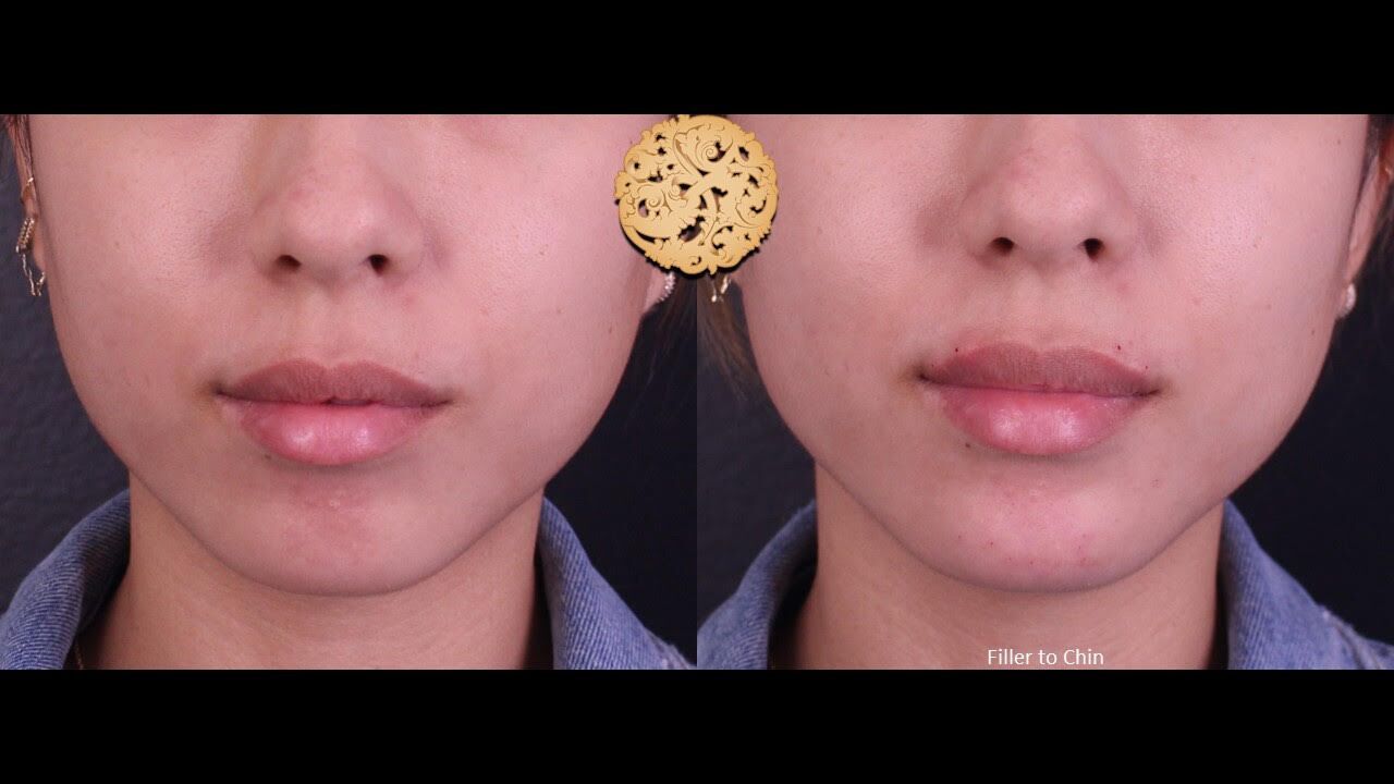 Chin Filler Before & After