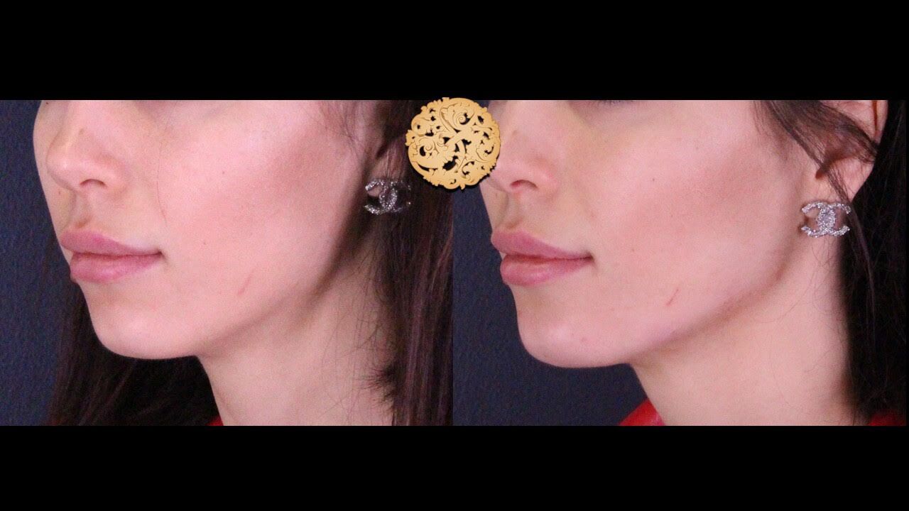 Chin Filler Before & After