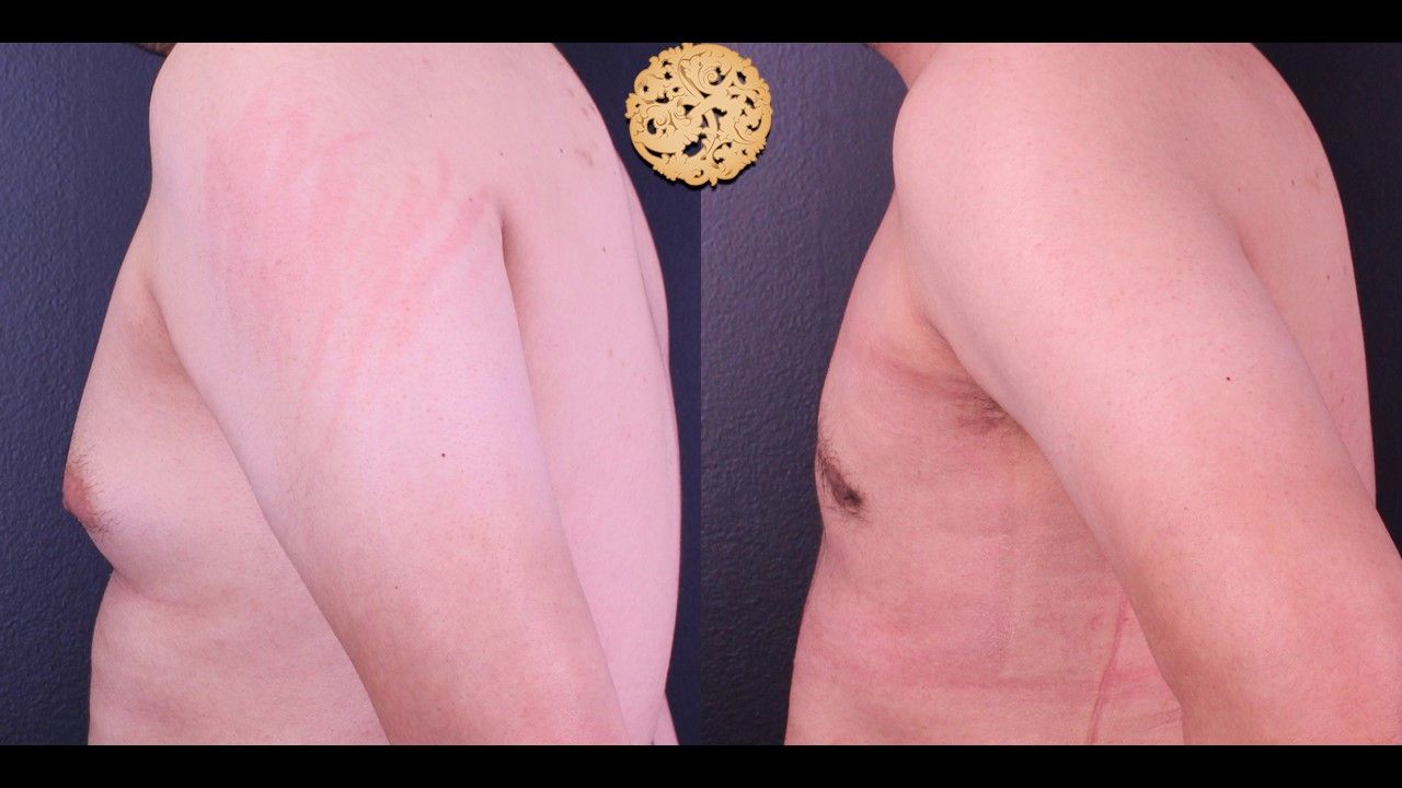 Gynecomastia Before & After