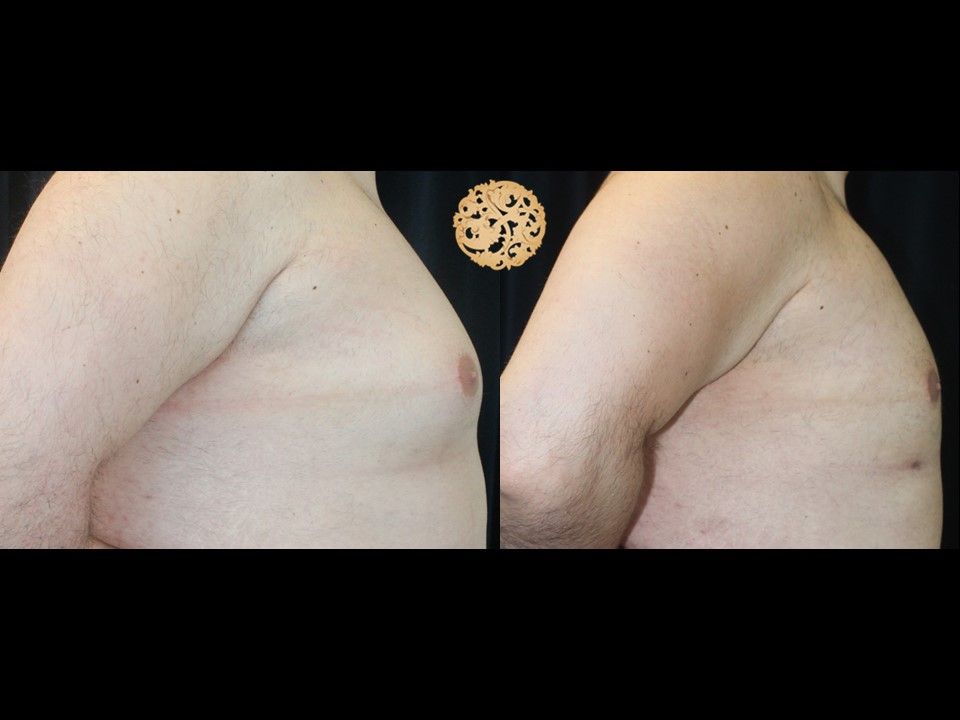 Gynecomastia Before & After