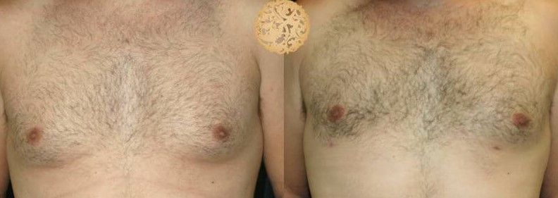 Gynecomastia Before & After