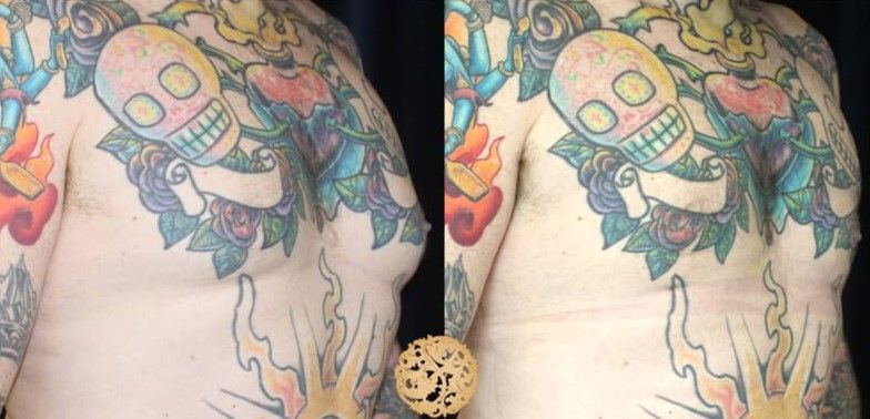 Gynecomastia Before & After