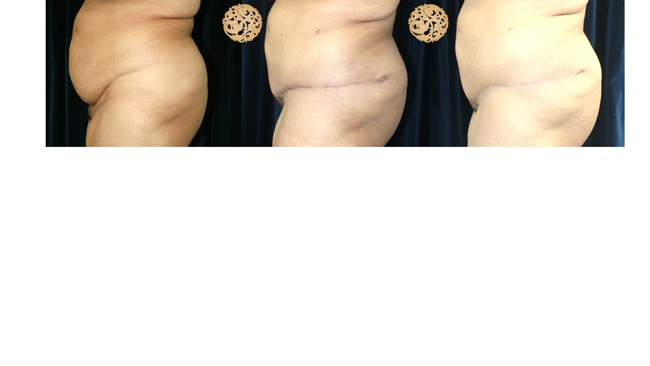 Panniculectomy Before & After