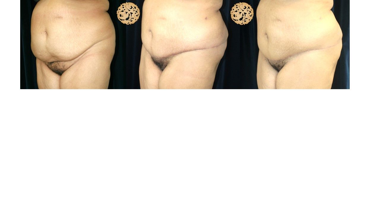 Panniculectomy Before & After