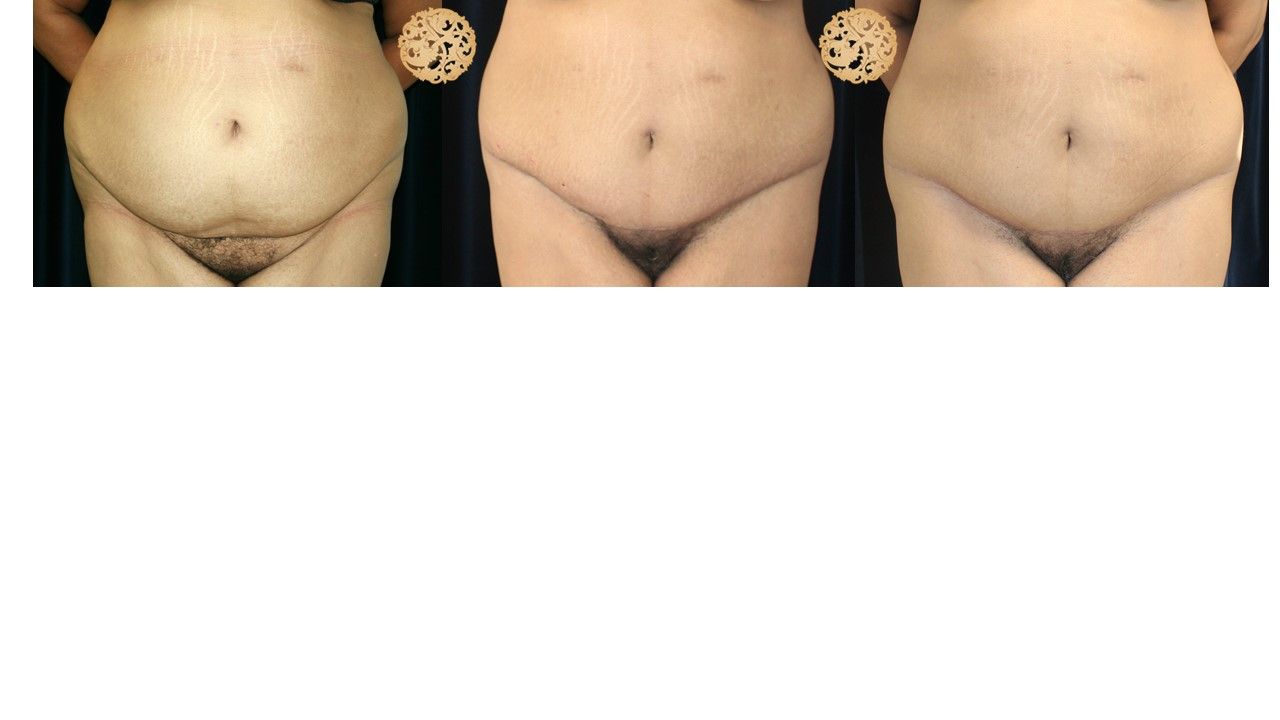 Panniculectomy Before & After