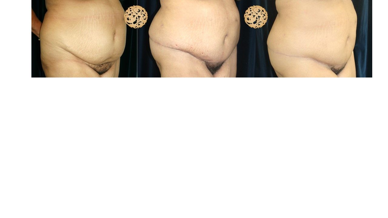 Panniculectomy Before & After