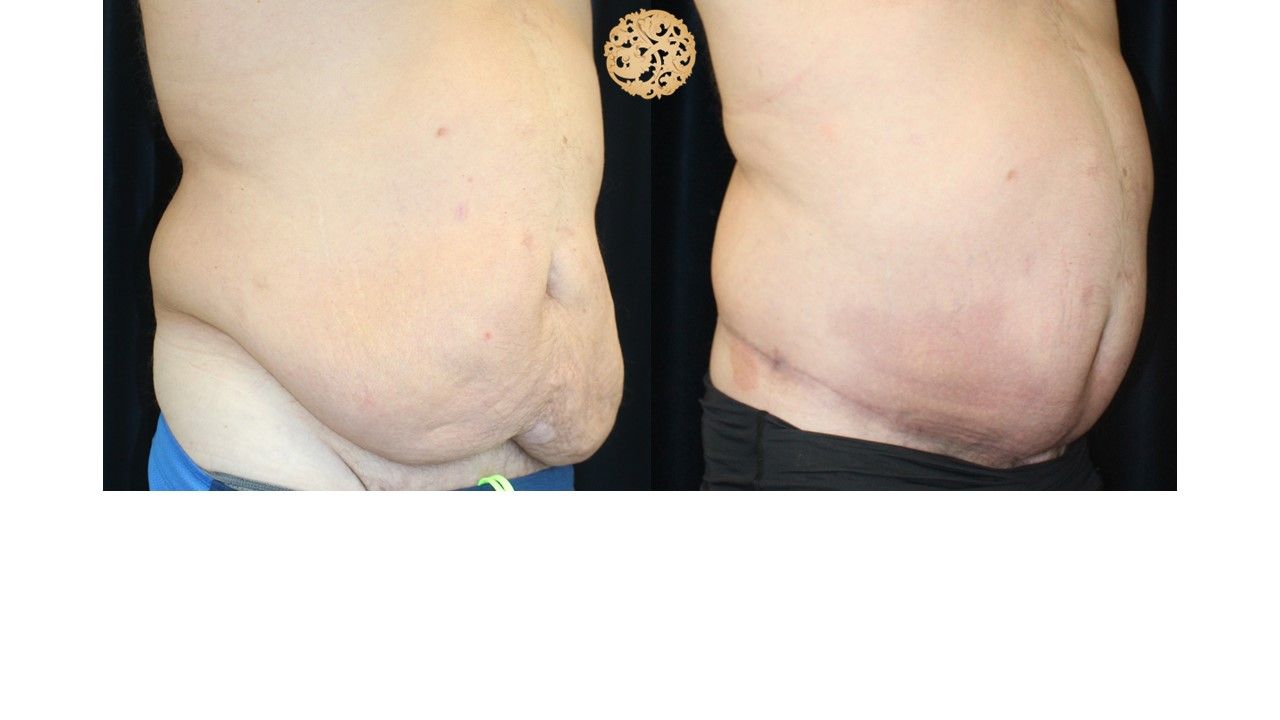 Panniculectomy Before & After
