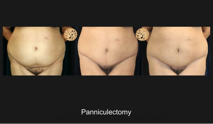 Panniculectomy Before & After