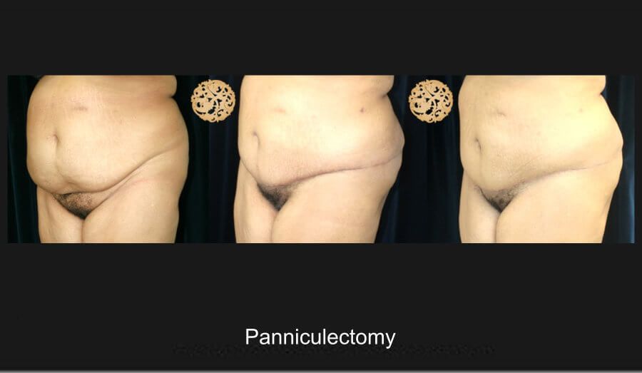 Panniculectomy Before & After