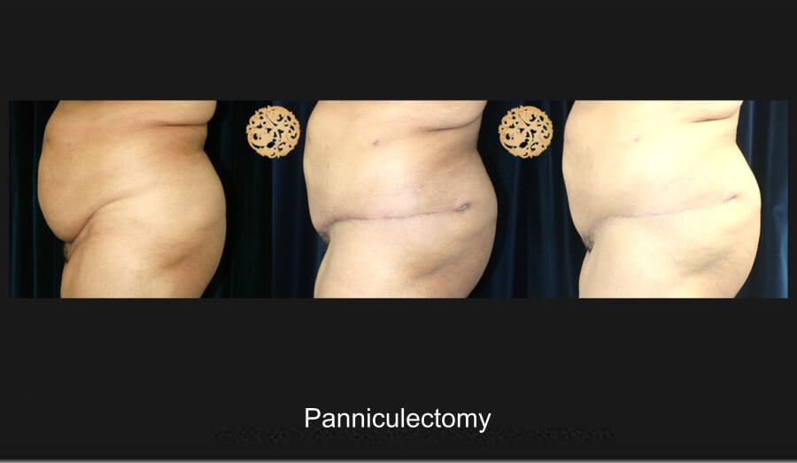 Panniculectomy Before & After