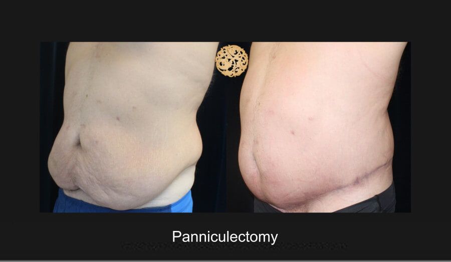 Panniculectomy Before & After