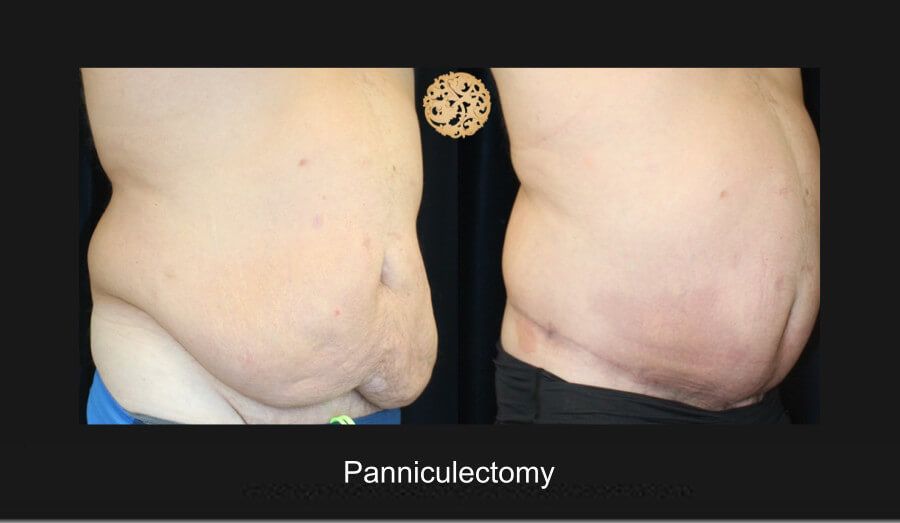 Panniculectomy Before & After