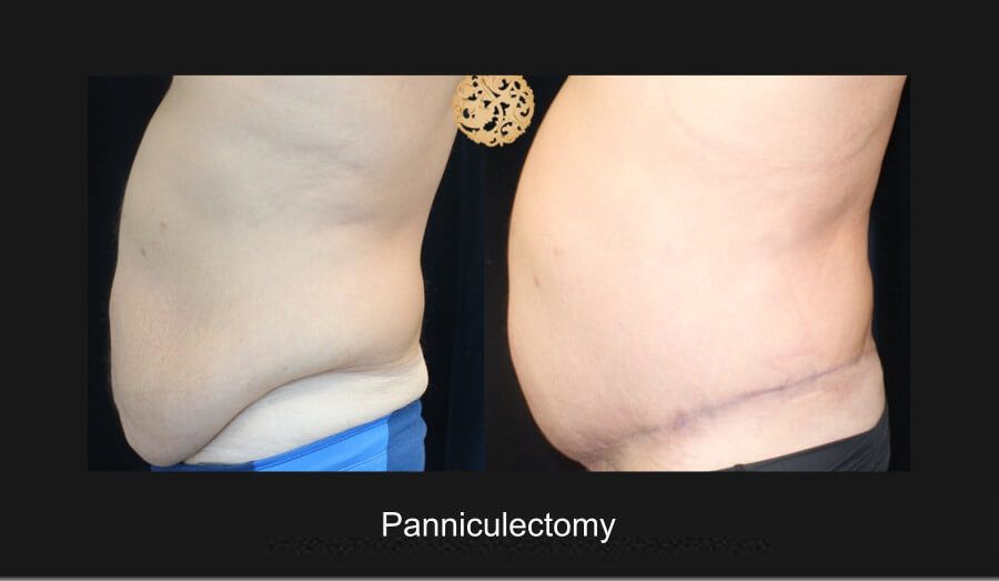 Panniculectomy Before & After