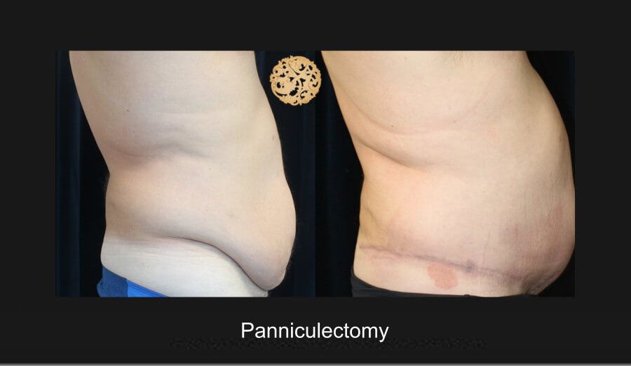 Panniculectomy Before & After