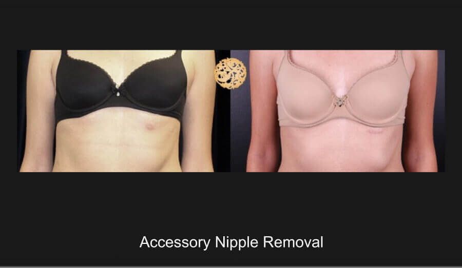 Accessory Nipple Removal Before & After