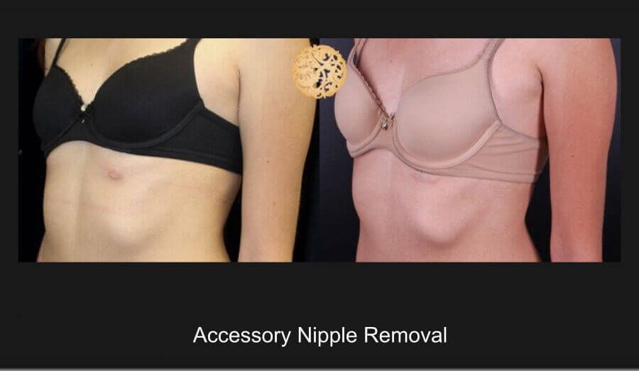 Accessory Nipple Removal Before & After