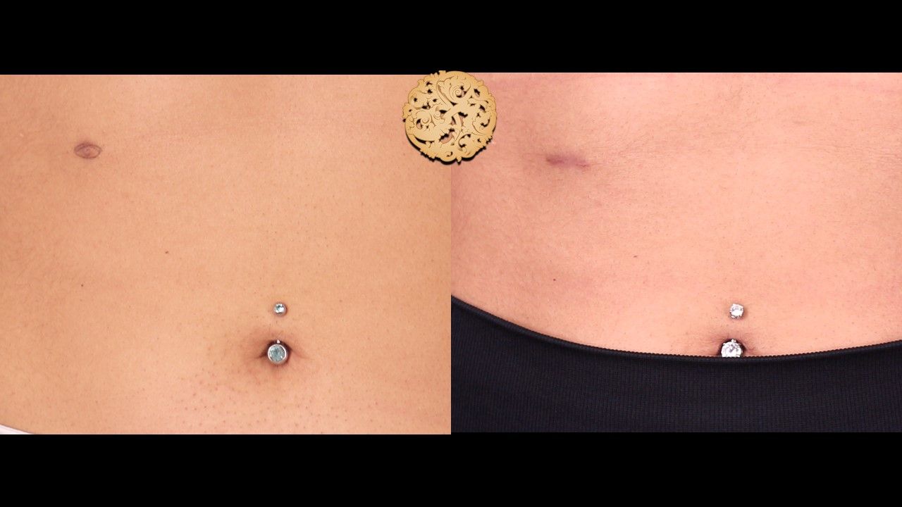Accessory Nipple Removal Before & After