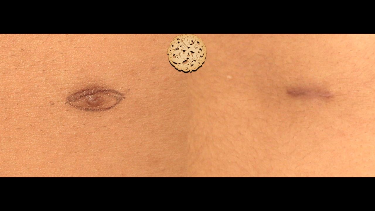 Accessory Nipple Removal Before & After