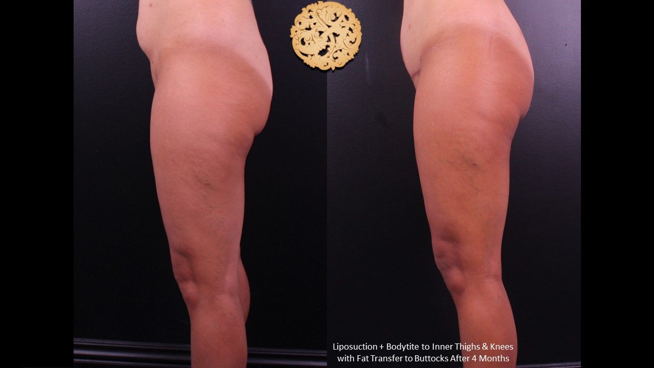 Brazilian Butt Lift Before & After