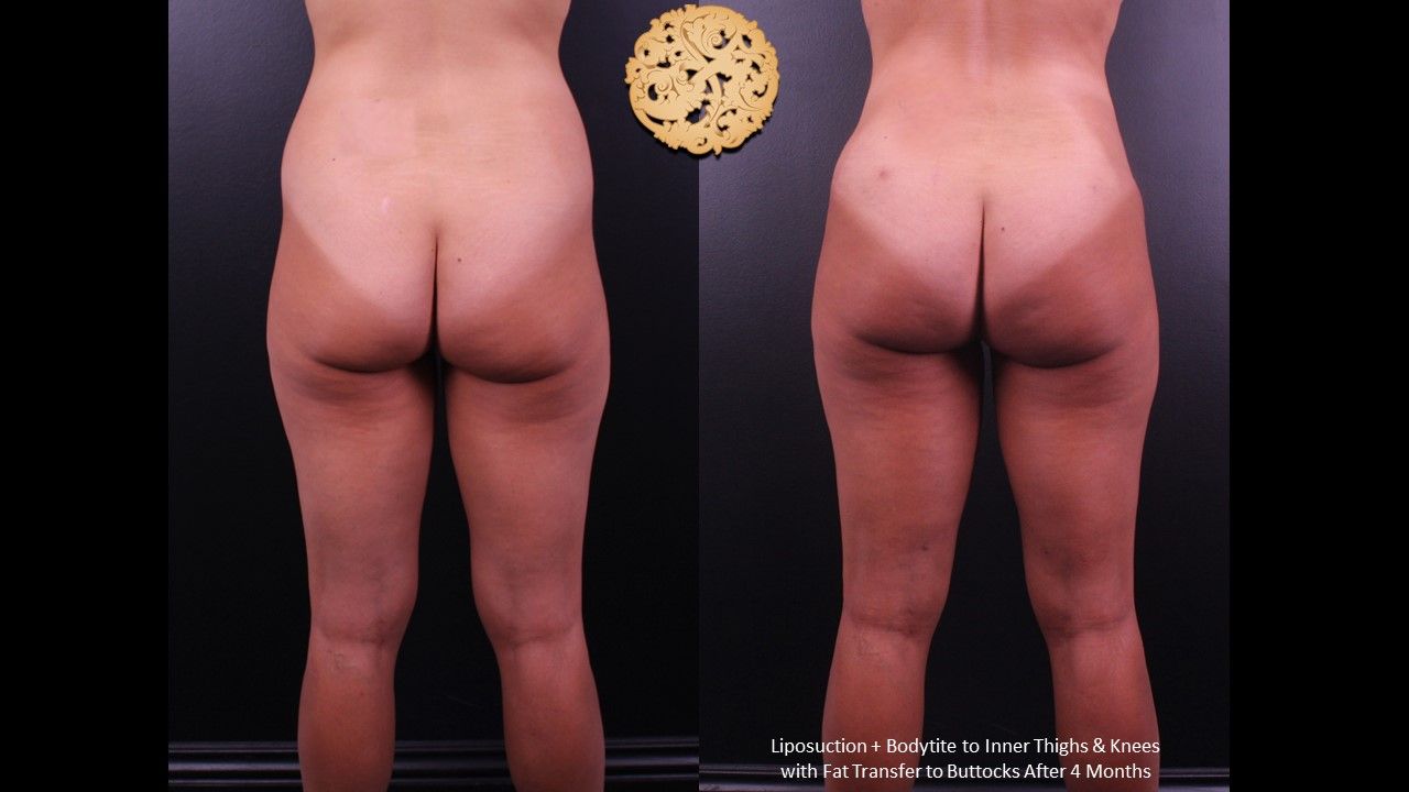 Brazilian Butt Lift Before & After