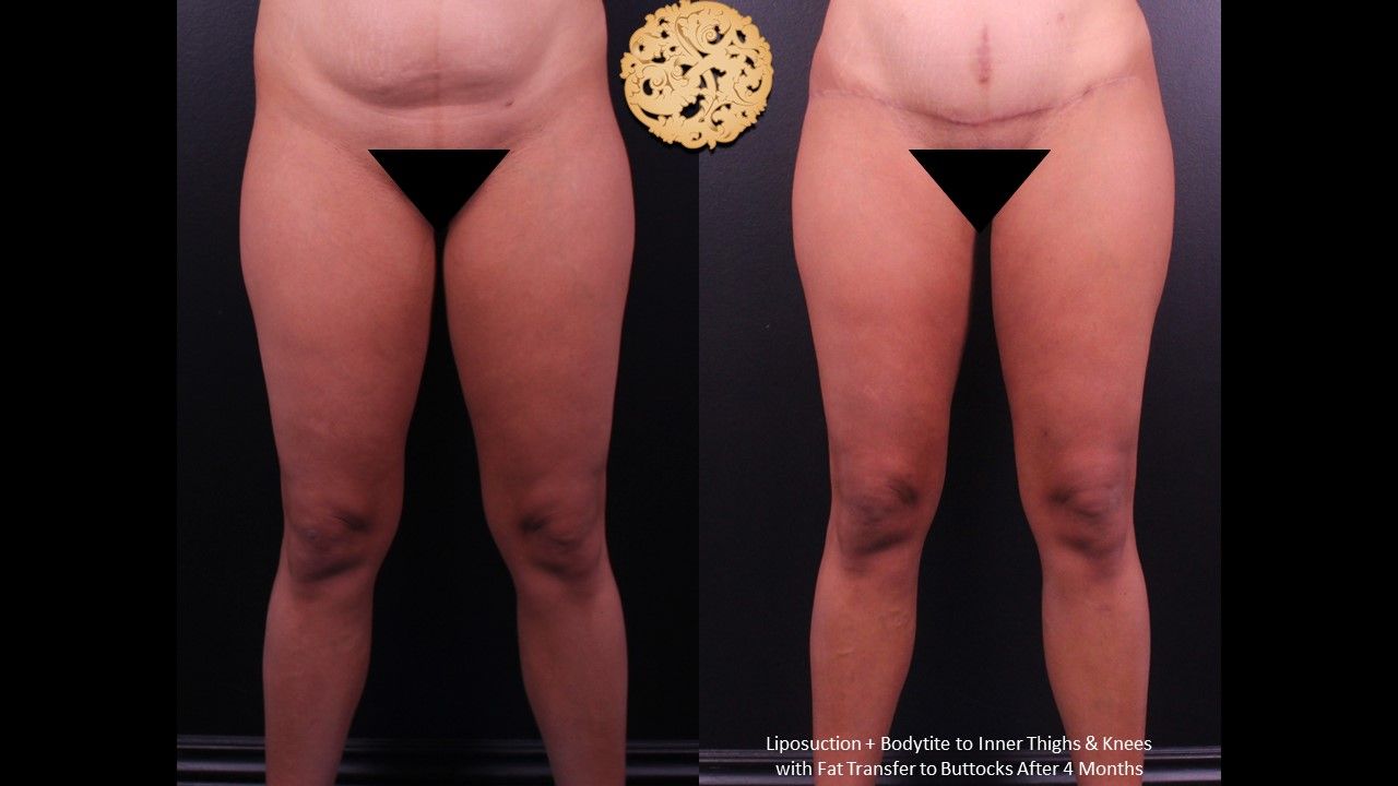 Brazilian Butt Lift Before & After