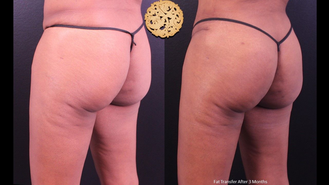 Brazilian Butt Lift Before & After