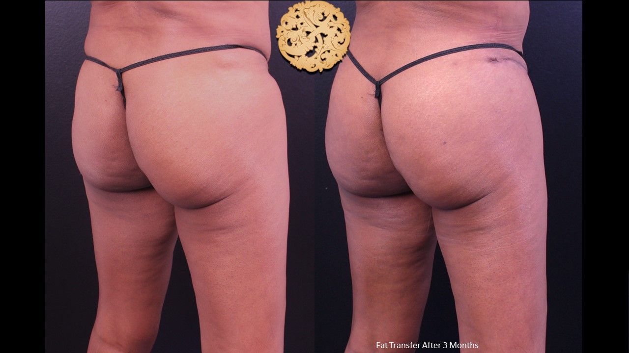 Brazilian Butt Lift Before & After