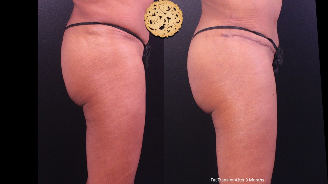 Brazilian Butt Lift Before & After