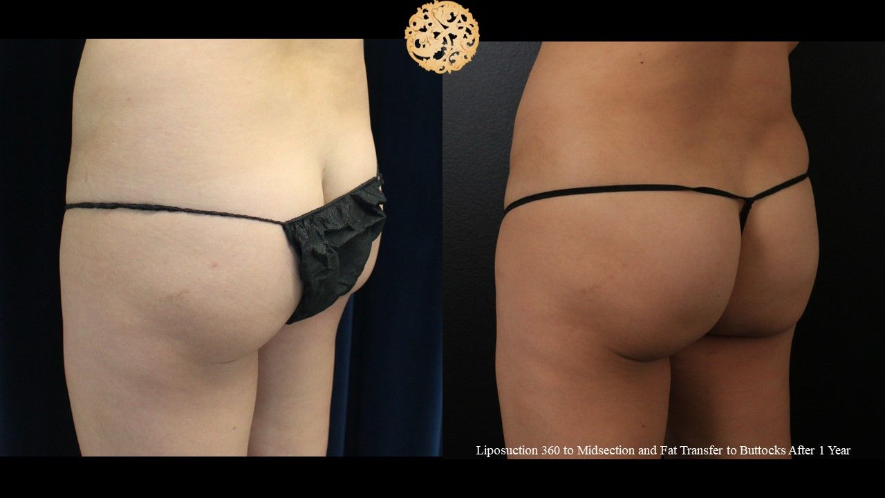 Brazilian Butt Lift Before & After