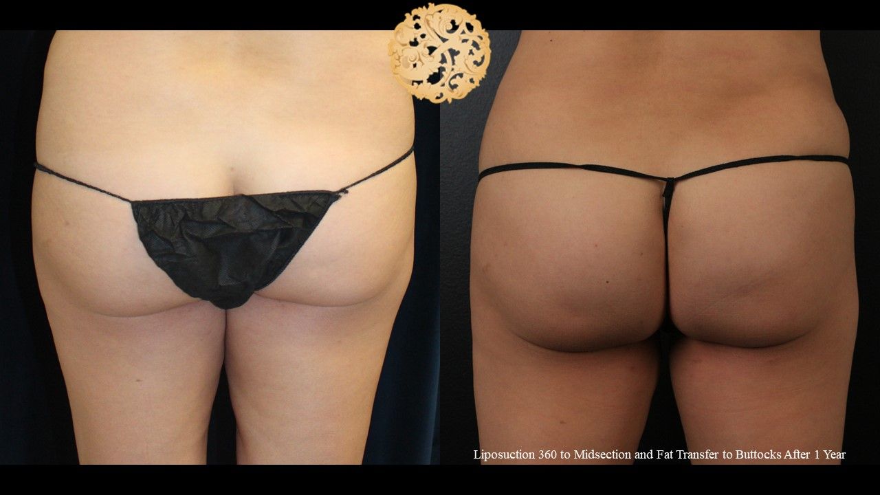 Brazilian Butt Lift Before & After