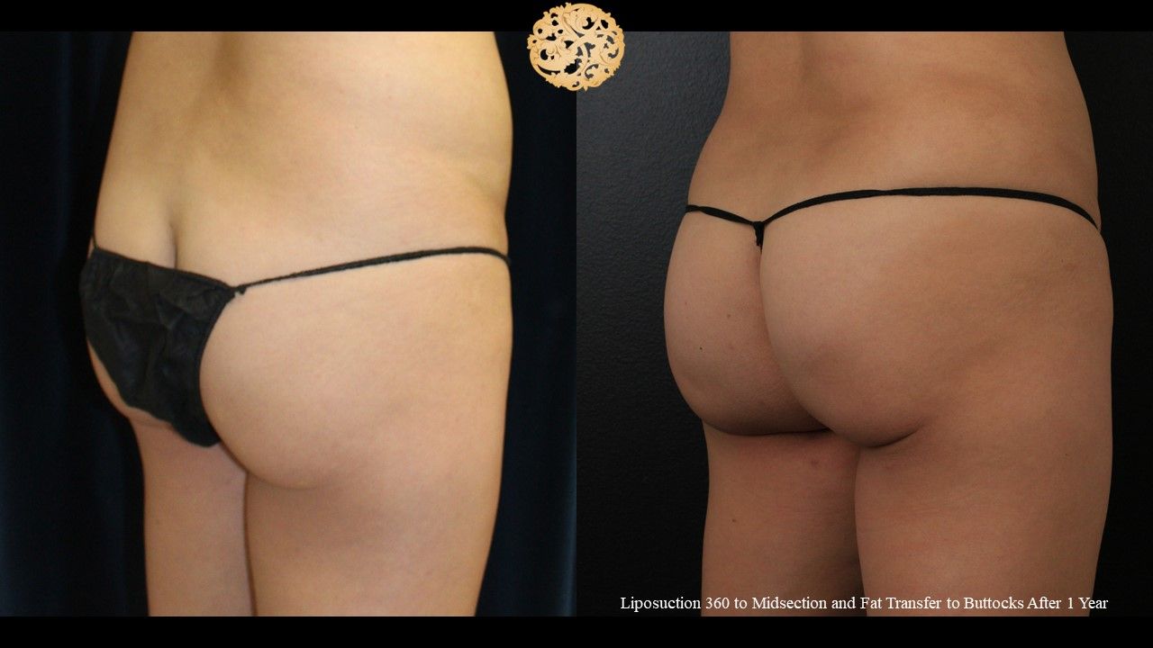Brazilian Butt Lift Before & After