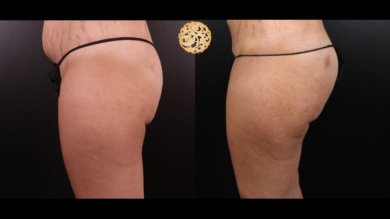 Brazilian Butt Lift Before & After