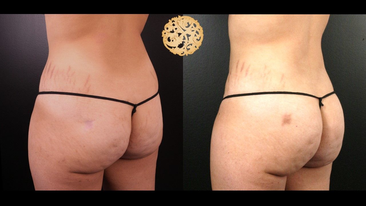 Brazilian Butt Lift Before & After