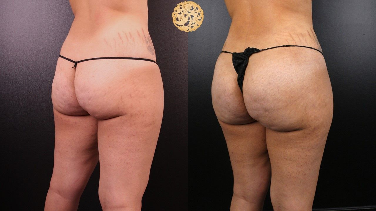 Brazilian Butt Lift Before & After