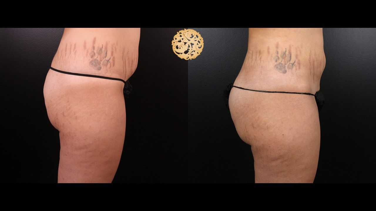 Brazilian Butt Lift Before & After