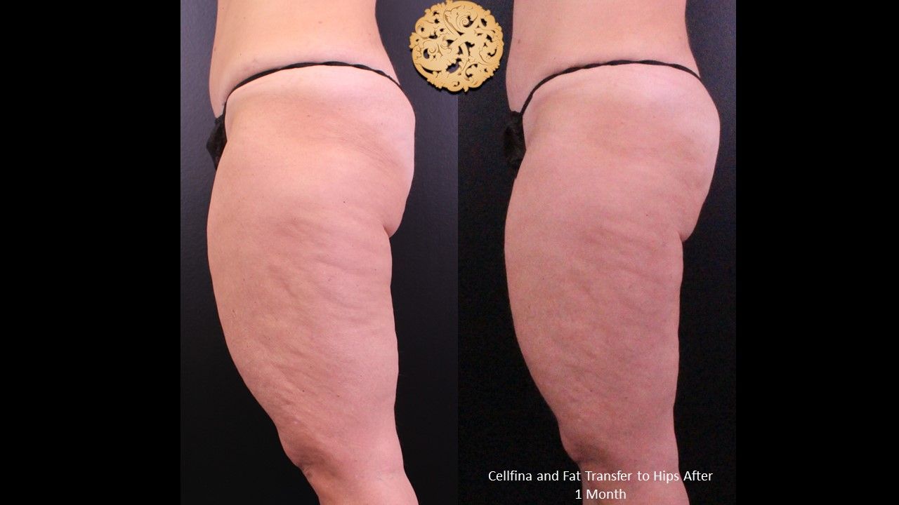 Brazilian Butt Lift Before & After