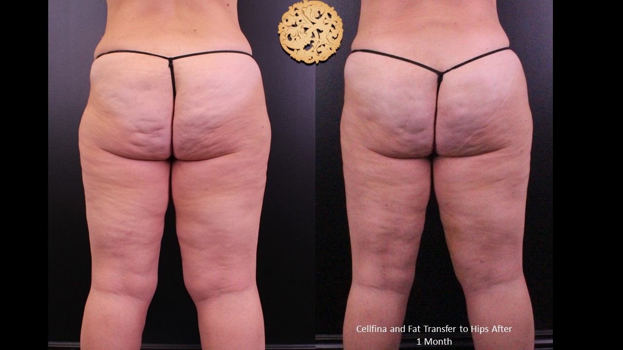Brazilian Butt Lift Before & After