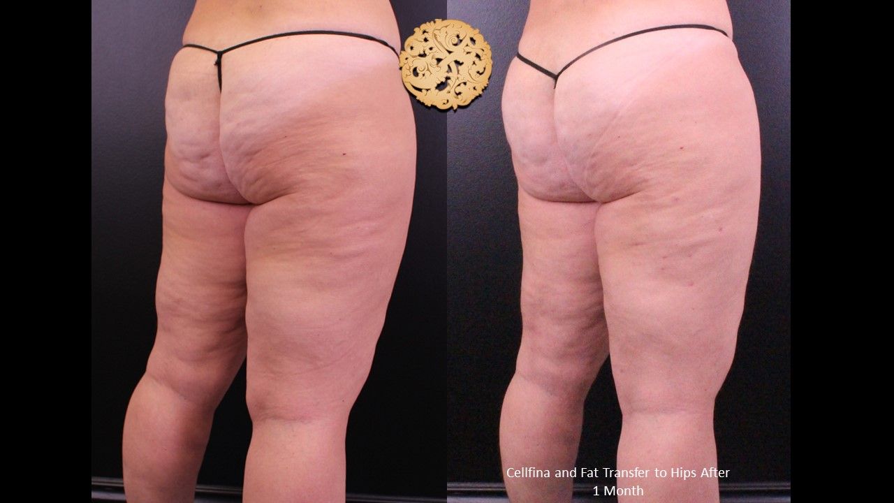 Brazilian Butt Lift Before & After