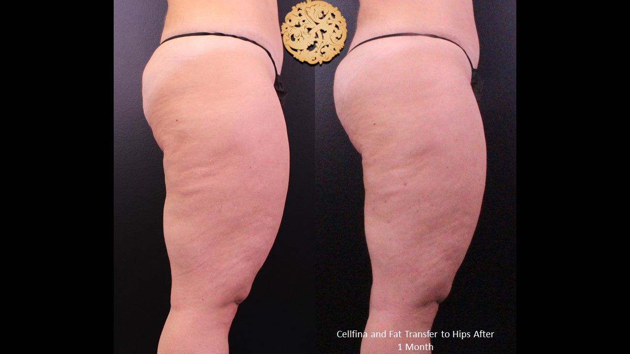 Brazilian Butt Lift Before & After