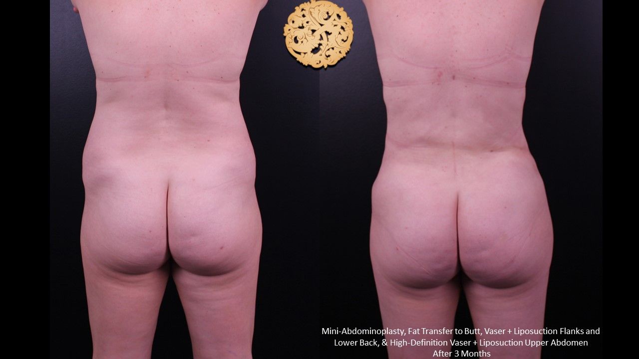 Brazilian Butt Lift Before & After