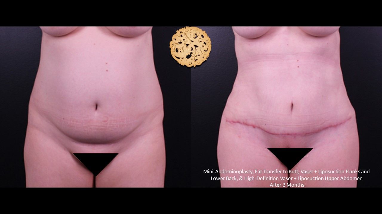 Brazilian Butt Lift Before & After