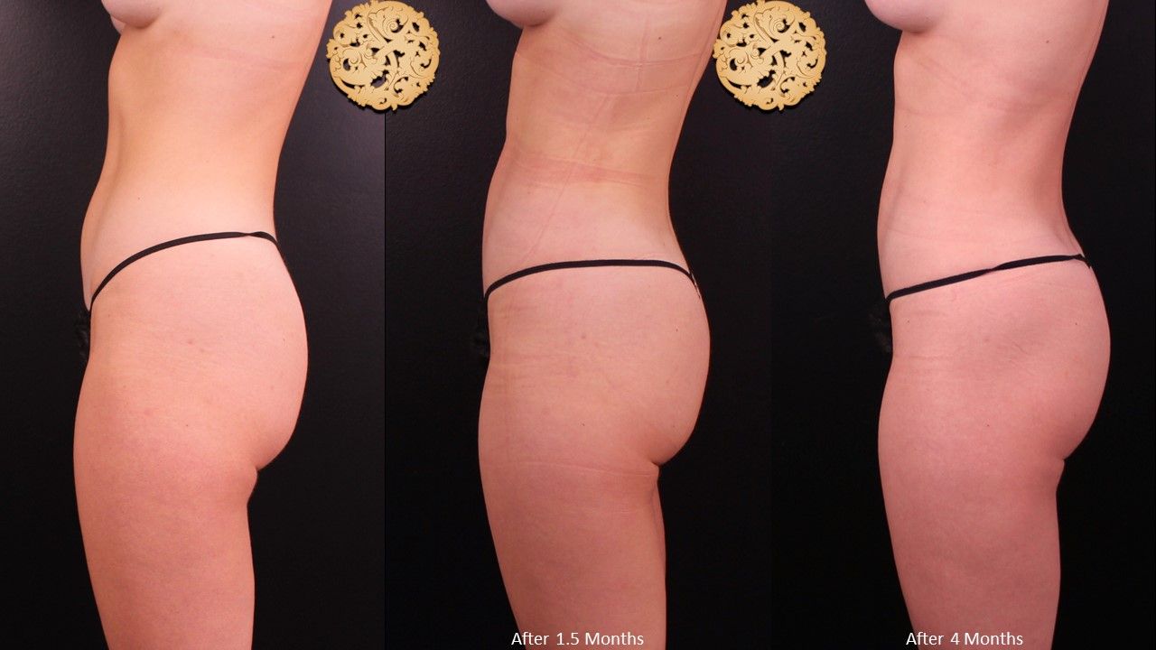 Brazilian Butt Lift Before & After
