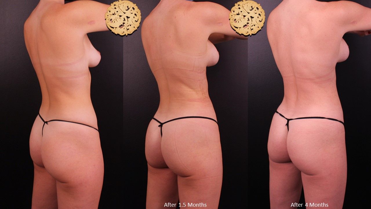 Brazilian Butt Lift Before & After