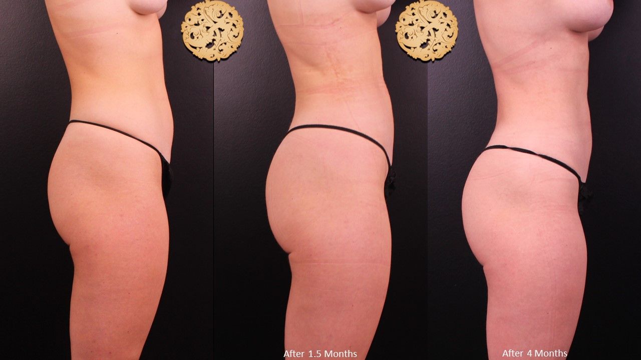 Brazilian Butt Lift Before & After