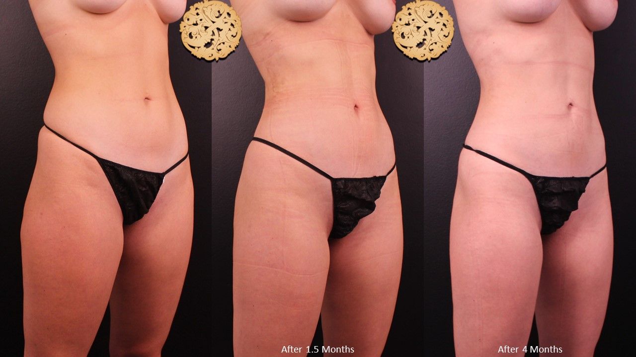 Brazilian Butt Lift Before & After