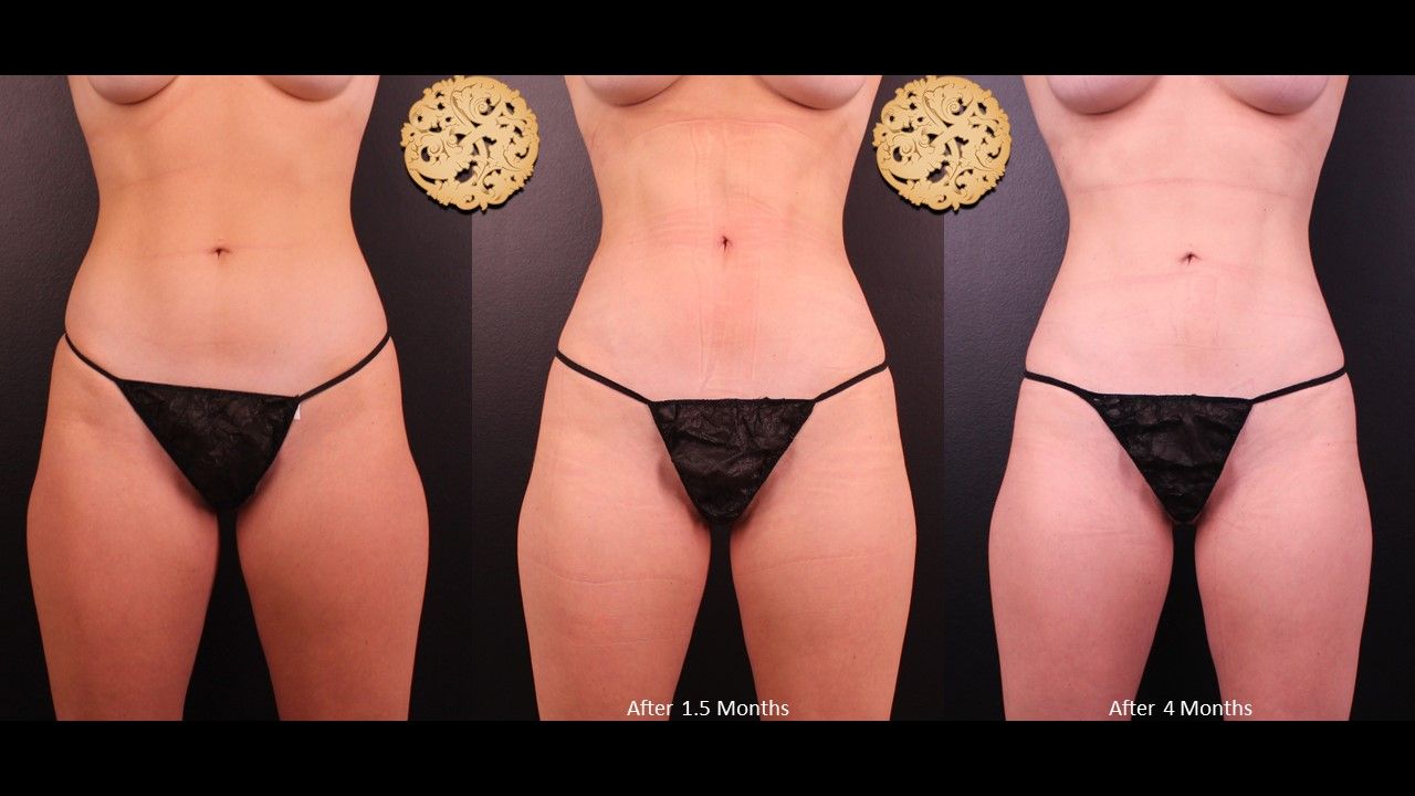 Brazilian Butt Lift Before & After
