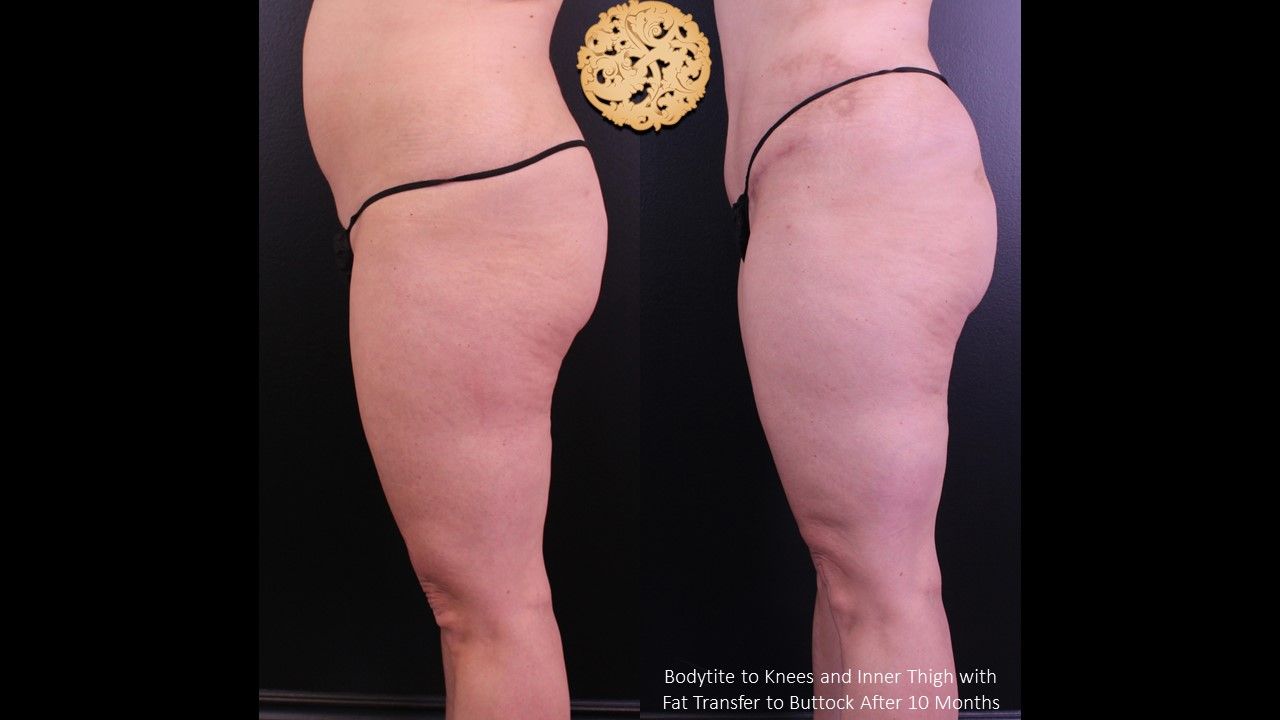 Brazilian Butt Lift Before & After