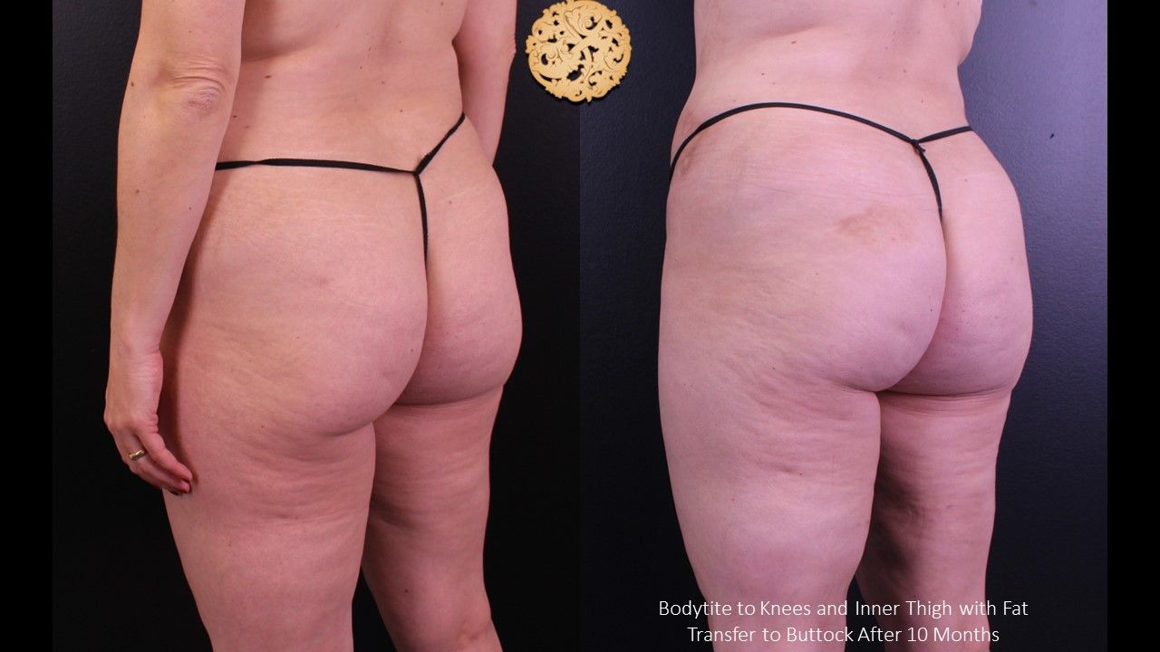 Brazilian Butt Lift Before & After