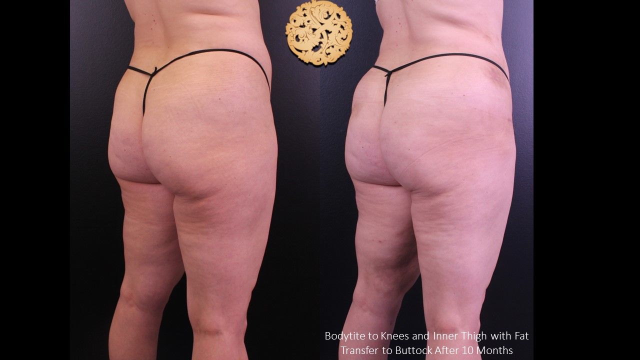 Brazilian Butt Lift Before & After