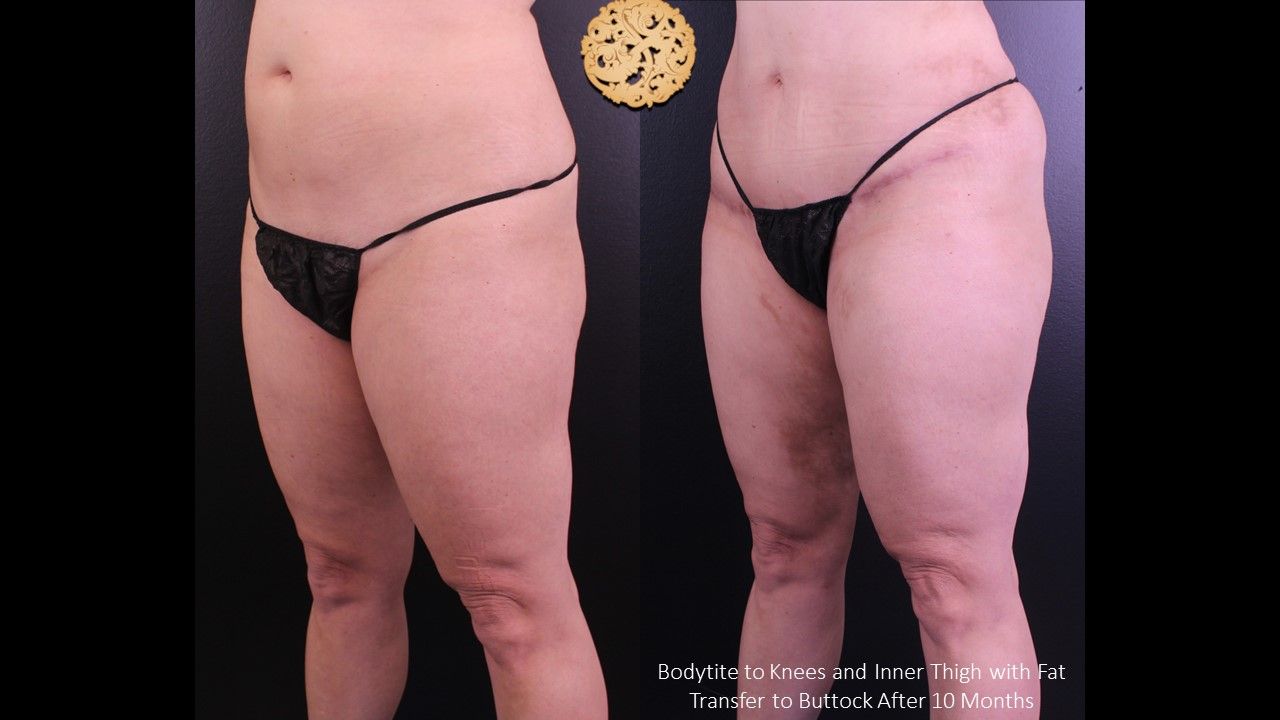 Brazilian Butt Lift Before & After